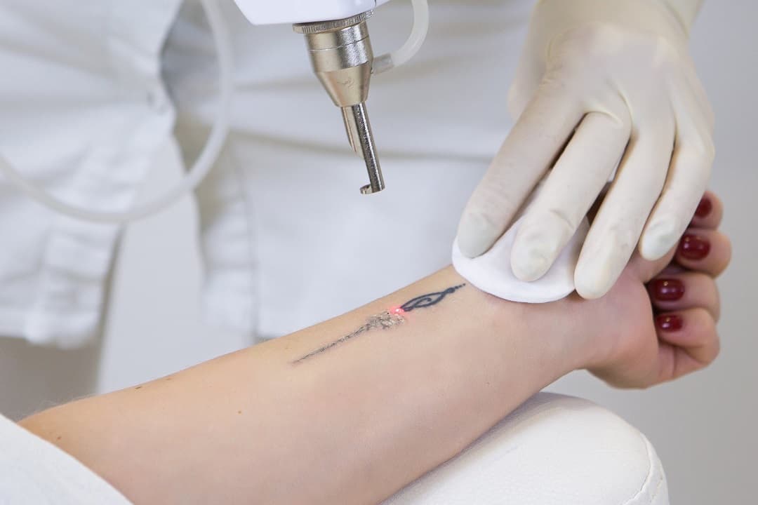 Serviciu Laser la Madiny Tattoo București